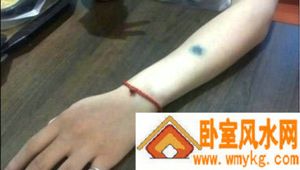 胳膊上的胎记代表什么? 胳膊上的胎记代表什么?